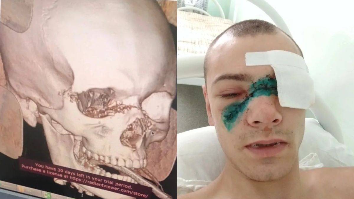 Пострадавший на стройке в Шерегеше