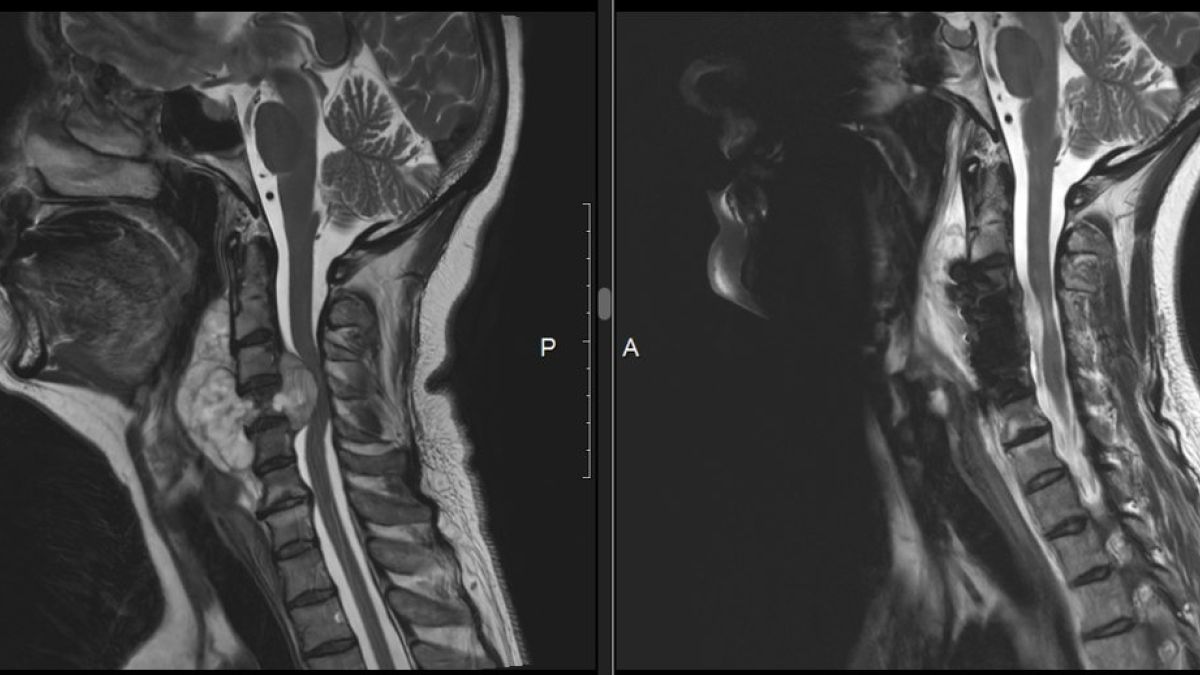Рентгеновские снимки опухоли