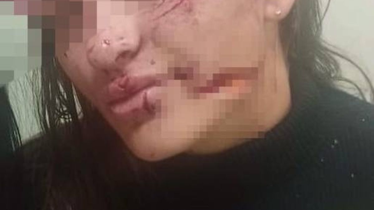 Девушке разбили стакан о лицо в Белокурихе