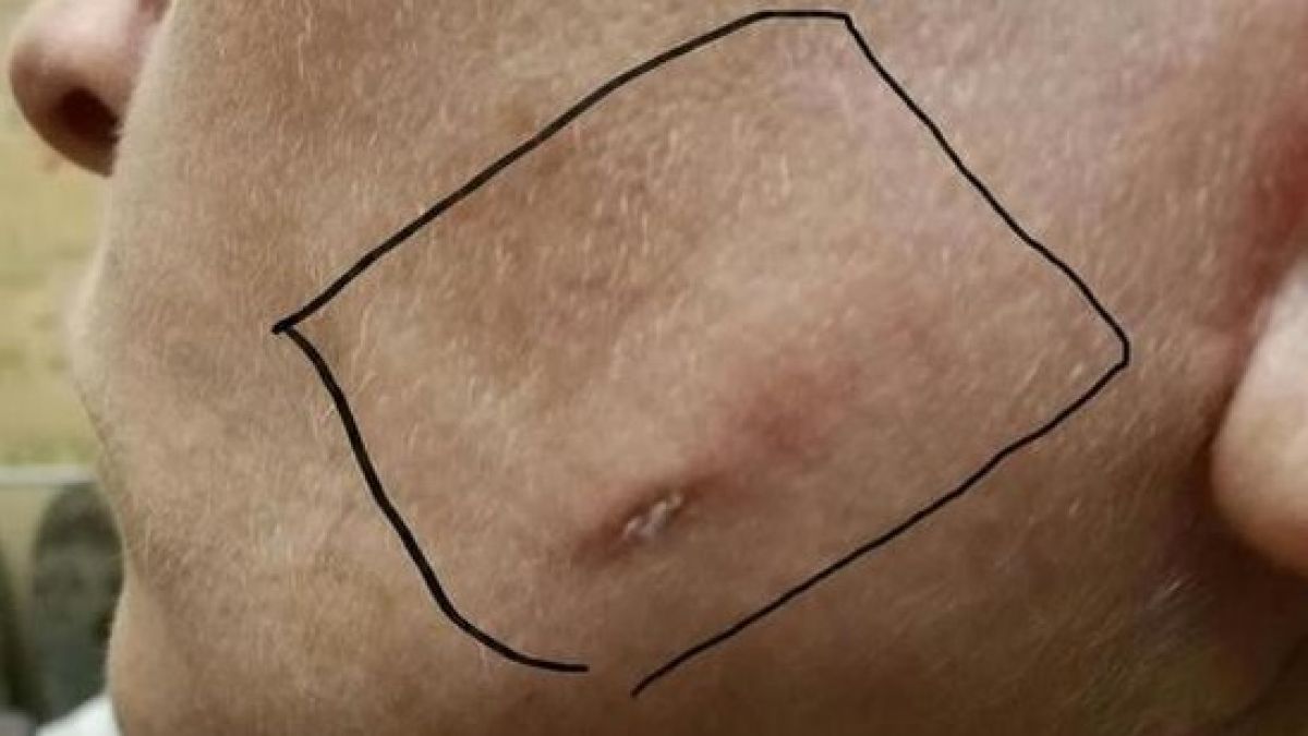 Сотруднице медцентра на Алтае изуродовали лицо, оставив под кожей салфетку