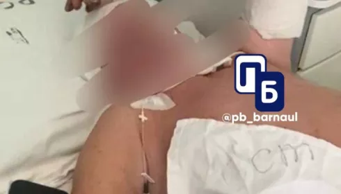 Переломы рук, пробита голова: пенсионера избили в Барнауле