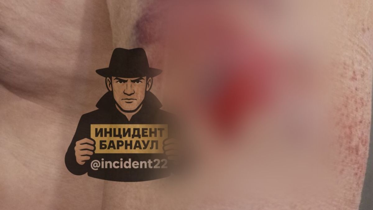 Соцсети: туристы из Сочи стреляли в дальнобойщика в Сростках Травма у дальнобойщика
