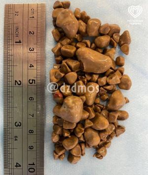 Камни из почек