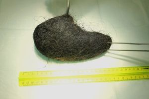 Волосы, удаленные из желудка