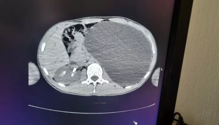 Почка увеличилась до пяти литров и едва не лопнула внутри юного новосибирца