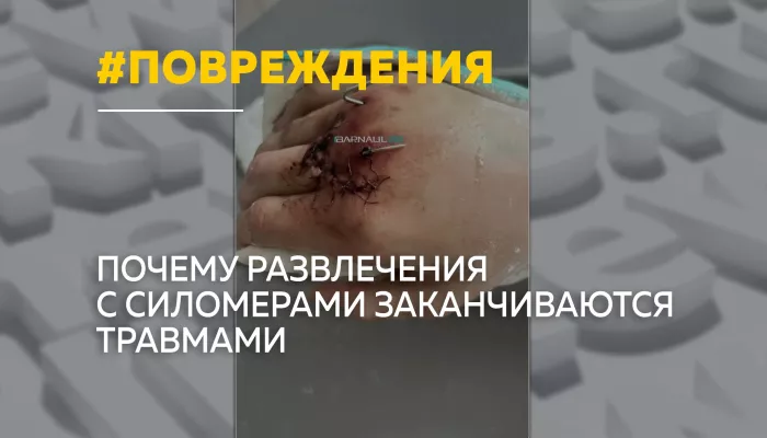 Цена рекорда: барнаульцы все чаще получают переломы после ударов по силомерам