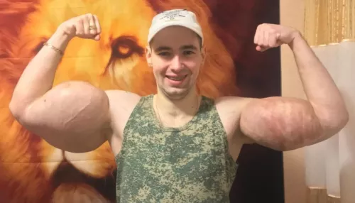 Не могут стабилизировать: Рукам-базукам грозит ампутация рук